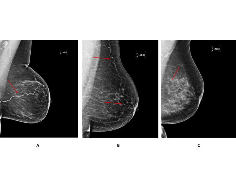 Examples of mammograms showing breast arterial calcification.  (Photo courtesy Circulation: Cardiovascular Imaging)
