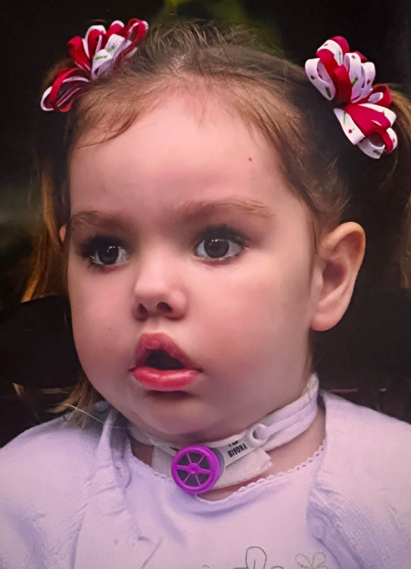 Abbie underwent a tracheostomy three weeks after the injury. She had it for about nine months. The purple cap helped her make sounds, the first crucial indication of her desire and ability to communicate. (Photo courtesy of the Vara family)