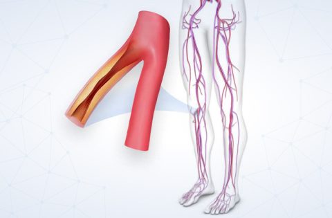 vascular disease illustration
